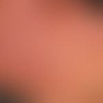 Airborne&nbsp;Contact Dermatitis: Chronische,massiv&nbsp;juckende und brennende, lichenifizierte&...