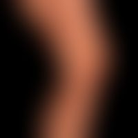 Scleroderma circumscripts: Band-like form of the scleroderma focus on the upper and lower leg. cl...