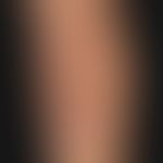Sklerodermie zirkumskripte, atrophisierender Typ (Atrophodermia idiopathica et progressiva&nbsp;P...