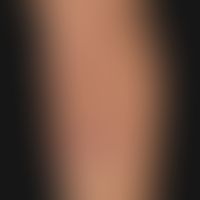 Scleroderma circumscribed, atrophying type (Atrophodermia idiopathica et progressiva Pasini-Pieri...