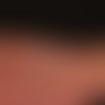 Teleangiektasia hereditaria haemorrhagica: Multiple Teleangiektasien und kleine rundliche Angiome...