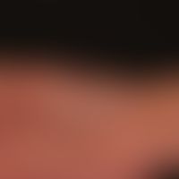 Teleangiektasia hereditaria haemorrhagica: Multiple Teleangiektasien und kleine rundliche Angiome...
