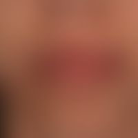 Teleangiectasia hereditaria haemorrhagica. Multiple, chronisch stationäre, seit Jahren unmerklich...