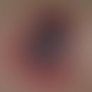 Thrombozytopenie, heparininduzierte: Ausbildung einer sog. Heaparinnekrose mit großflächgiger, sc...
