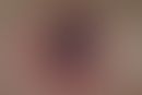 Thrombozytopenie, heparininduzierte: Ausbildung einer sog. Heaparinnekrose mit großflächgiger, sc...