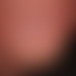 Trachyonychie: Rauigkeit der Nagelplatte durch längsverlaufende Wachstumsstörungen.
