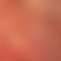 Teleangiektasie: Detailaufnahme.
