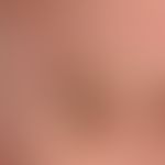 Sebaceous gland hyperplasia: Soft, yellowish papules which have existed for years, slowly increas...