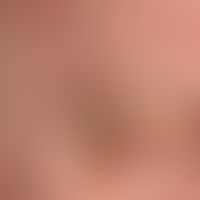 Sebaceous gland hyperplasia: Soft, yellowish papules which have existed for years, slowly increas...
