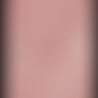 Sebaceous gland hyperplasia, senile. 74-year-old patient noticed these completely asymptomatic sk...