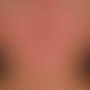 Teleangiectasia macularis eruptiva perstans, for years slowly progressive "skin redness" from den...