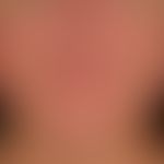 Teleangiectasia macularis eruptiva perstans. Seit Jahren langsam progrediente "Hautrötung" aus di...