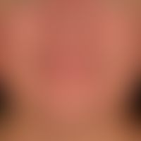 Teleangiectasia macularis eruptiva perstans, for years slowly progressive "skin redness" from den...