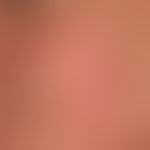 Teleangiectasia macularis eruptiva perstans. Seit Jahren langsam progrediente "Hautrötung" aus di...