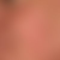 Teleangiectasia macularis eruptiva perstans, for years slowly progressive "skin redness" from den...