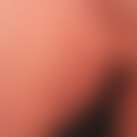 Tinea inguinalis: Seit mehreren Monaten bestehende, groblamellär schuppende und mäßig juckende Pl...