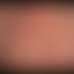 UV-Strahlen: Chronischer UV-Schaden der Haut. Poikilodermischer Zustand, zahlreiche solare Lentig...