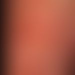 Necrobiosis lipoidica mit multiplen Teleangiektasien und einem zentralen Ulcus cruris.
