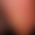Verrucae plantares. multiple solid verrucae, solid papules, which in places are also aggregated. ...