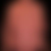 Side effects of vemurafenib: Erythroderma with pronounced keratosis areolae mammae (acquisita) un...
