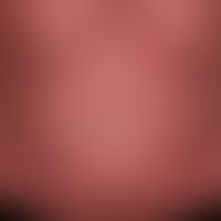 Keratosis areaolae mammae unter Vemurafenib-Therapie. &nbsp;Detailaufnahme.
