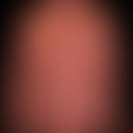 Erythrodermie unter Vemurafenib-Therapie. Ausgeprägte&nbsp;Keratosis areolae mammae (acquisita).
