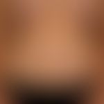 Virusexantheme: Teils makulöses, teils urtikarielles Exanthem; begleitend Fieber, Entzündungspara...