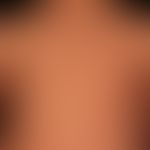 Virusexantheme: Ätillogische ungeklärtes (Diagnose per Ausschluß) psoriasiform schuppendes Exanth...