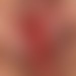 Vulvitis chronica circumscripta plamacellularis: Chronic, painful, deep red inflammation of the l...