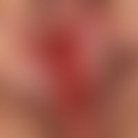 Vulvitis chronica circumscripta plamacellularis: Chronic, painful, deep red inflammation of the l...