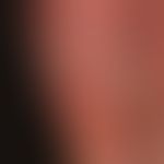 Venous insufficiency chronic: Massive congestive dermatitis with papillomatosius cutis and intial...