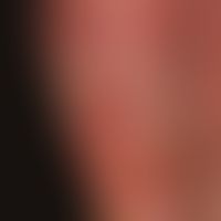 Venous insufficiency chronic: Massive congestive dermatitis with papillomatosius cutis and intial...