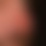 Wegener's granulomatosis, localized stage: Laved localized early form, initial clinically unexpla...