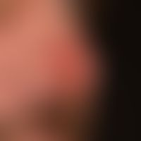 Granulomatose mit Polyangiitis&nbsp;(Wegener-Granulomatose: lokalisiertes Stadium: Lavierte lokal...