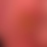 Zytomegalie-Ulkus: Foudroyant sich entwicklendes Ulkus am -skortum bei einem HIV-Infizierten.
