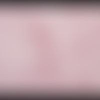 Xanthomas, eruptive. chronically active clinical picture with disseminated, 0.1-0.3 cm large, fla...