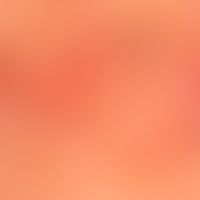 Basal cell carcinoma nodular (detailed picture), characterized by the bizarre "tumor vessels" mar...