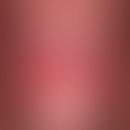 Balanitis plasmacellularis: Chronische Balanitis&nbsp;bei einem 67 Jahre alten Patienten.&nbsp;Ke...