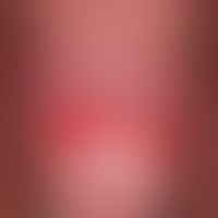 Balanitis plasmacellularis: Chronische Balanitis&nbsp;bei einem 67 Jahre alten Patienten.&nbsp;Ke...