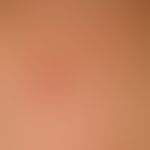Molluscum contagiosum:&nbsp;multiple Mollusca contagiosa, hier gruppiert, angedeutet linear angeo...