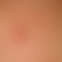 Molluscum contagiosum: multiple Mollusca contagiosa, here grouped, indicated linearly arranged, d...