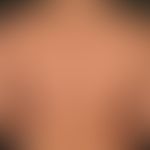 Molluscum contagiosum: disseminierte&nbsp; Mollusca contagiosa bei einem immunkompetenten Patient...