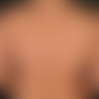 Molluscum contagiosum: disseminated mollusca contagiosa in an immunocompetent patient, known alle...