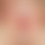 lichen sclerosus of the vulva.: whitish-porcelain-like skin of the large labia, also those at the...