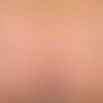 Urticaria pigmentosa adultorum: Classical form of cutaneous mastocytosis (excess of mast cells in...