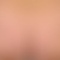 Urticaria pigmentosa adultorum: Classical form of cutaneous mastocytosis (excess of mast cells in...