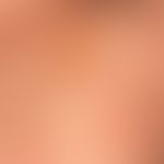 diffuse cutaneous mastocytosis, with uniform waxy skin texture and artificial (subepithelial) bli...