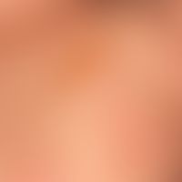 diffuse cutaneous mastocytosis, with uniform waxy skin texture and artificial (subepithelial) bli...