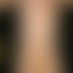 Mastocytosis diffuse of the skin: Disseminated large-area mastocytosis of the skin (type Ia). In ...