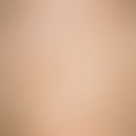 Mastocytosis diffuse of the skin: Disseminated large-area mastocytosis of the skin (type Ia); no ...